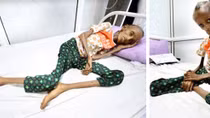 Nụ cười của cô gái Yemen 18 tuổi gầy như “xác khô” sau nội chiến