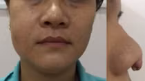 Những "ngộ nhận" dẫn tới thảm họa sau làm đẹp