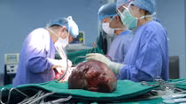 Suýt vỡ gan vì khối u khổng lồ