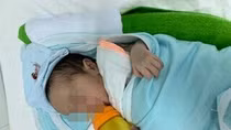 Phẫu thuật cho bệnh nhi sơ sinh bị dị dạng đường dẫn khí phổi bẩm sinh
