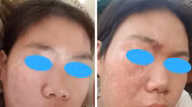 Ghép tế bào thượng bì tự thân không qua nuôi cấy điều trị bạch biến