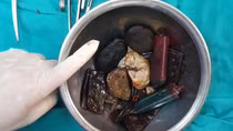 Hy hữu: Người đàn ông ăn được “tất cả mọi thứ”
