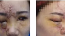 Thêm một cô gái có nguy cơ mù mắt do tiêm filler nâng mũi