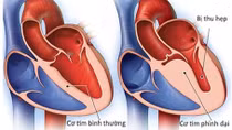 Chuyên gia khẳng định: Thông tin "virus lạ" gây viêm cơ tim là không có cơ sở