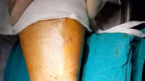 Cắt cỏ bị lưỡi cưa vỡ cắt đứt chân