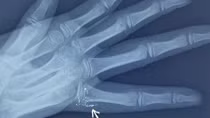 Một cháu bé bị nhiễm độc thủy ngân 