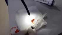 Mảnh ớt nằm trong phế quản 2 tháng suýt nhầm thành ung thư phổi