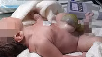 Ca phẫu thuật dị tật thoát vị hiếm gặp cho bé trai sơ sinh 