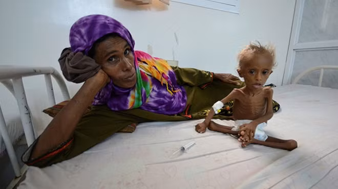 Trong các bệnh viện ở Yemen, người ta không khó để nhìn thấy cảnh nhiều em nhỏ gầy đến nỗi chỉ còn da bọc xương và ngồi lọt thỏm trong bàn tay người lớn dù đã 2-3 tuổi. Các chuyên gia cho biết, trong một số trường hợp, những đứa trẻ sẽ phải ở lại trong bệnh viện gần như cả đời để chữa trị vì sức khỏe của chúng đã cạn kiệt vì đói khát nhiều tháng.