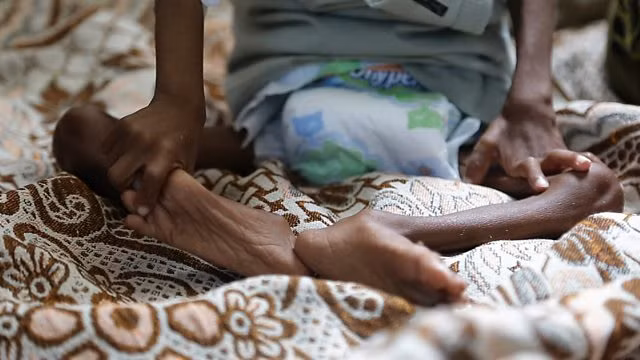 Đối với những đứa bé bị suy dinh dưỡng nghiêm trọng, chúng sẽ rơi vào tình trạng chậm phát triển và xương dễ vỡ. Dù được chăm sóc y tế thì chúng cũng không thể phát triển bình thường. Chúng sẽ có vóc dáng nhỏ bé hơn bạn bè và dễ mắc bệnh tật hơn.