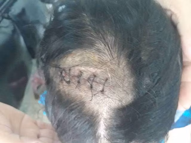 Vết thương trên vùng đầu của nữ nhân viên.