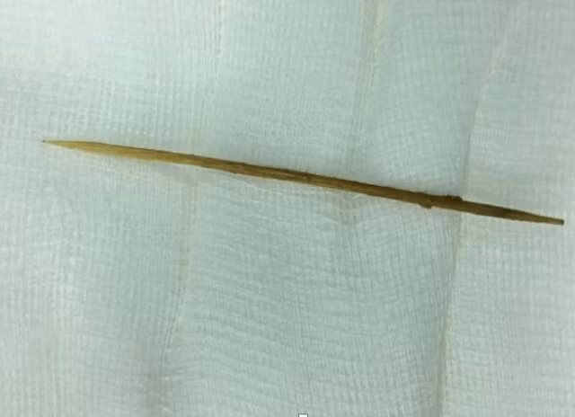 Tăm xỉa răng trong bụng bệnh nhân được bác sĩ phẫu thuật nội soi lấy ra ngoài.