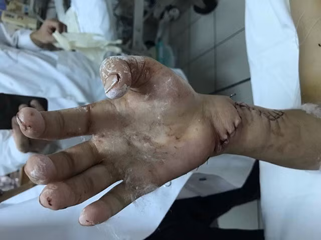 Bàn tay phải bị đứt lìa của bệnh nhân Linh được y, bác sĩ Trung tâm Chấn thương chỉnh hình, Bệnh viện Trung ương Huế nối lại thành công.