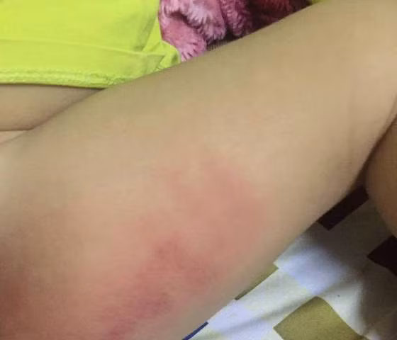 Vết bầm tím trên đùi cháu V.. Vết bầm tím trên đùi cháu V..