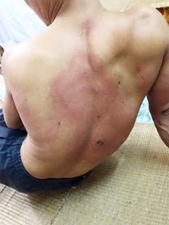 Phần lưng anh Chung bị kiến lạ cắn tấy đỏ, nổi mẩn. Phần lưng anh Chung bị kiến lạ cắn tấy đỏ, nổi mẩn.