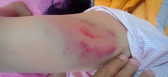 Những vết thương bầm tím trên cơ thể ông Thuỷ khi bị ông Khang đánh