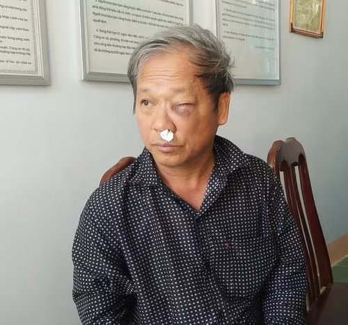 Phóng viên Hoàng Đình Chiểu với những vết thương trên mặt sau khi bị các đối tượng hành hung