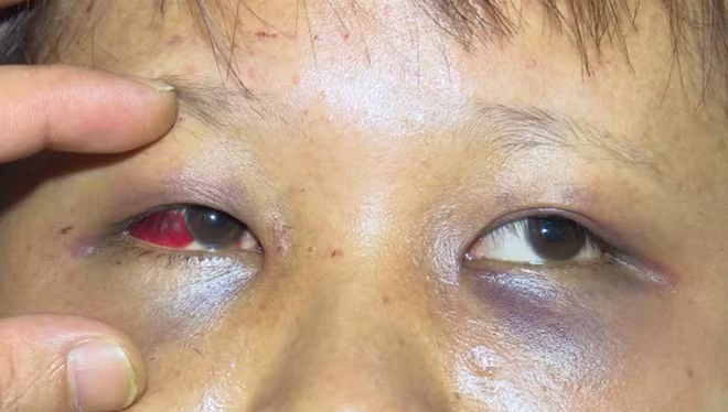 Những vết thương bầm tím trên người và mặt em Q. do bị Thái tra tấn