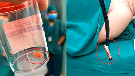 Dị vật được các bác sĩ lấy ra từ trong người trẻ nhỏ.