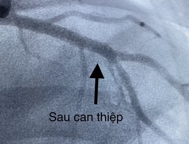 Và sau khi can thiệp thành công.