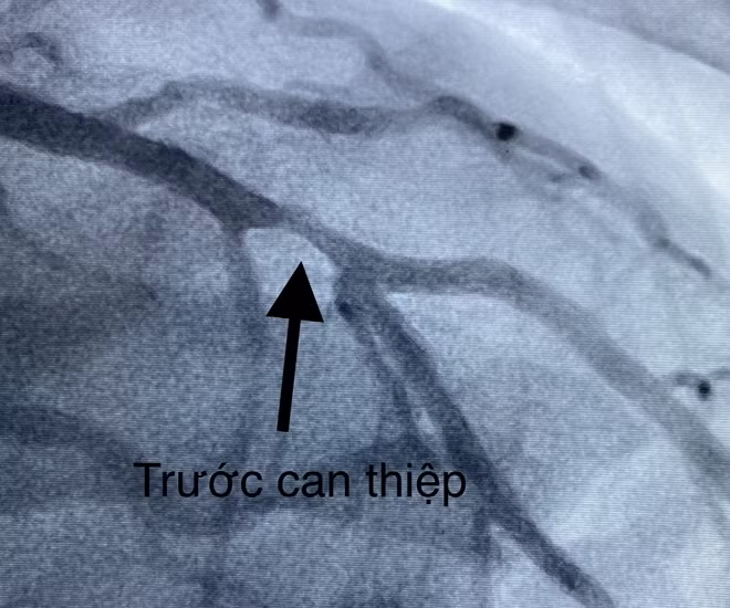 Hình ảnh tắc mạch vành trước khi can thiệp.