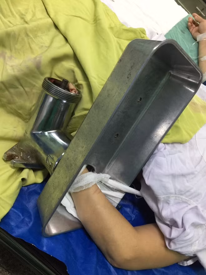 Bệnh nhân vào viện với cả máy xay.