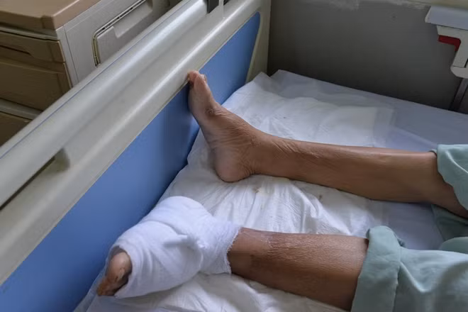 Một bệnh nhân bị nhiễm trùng ở chân nặng do kéo dài thời gian khám bệnh
