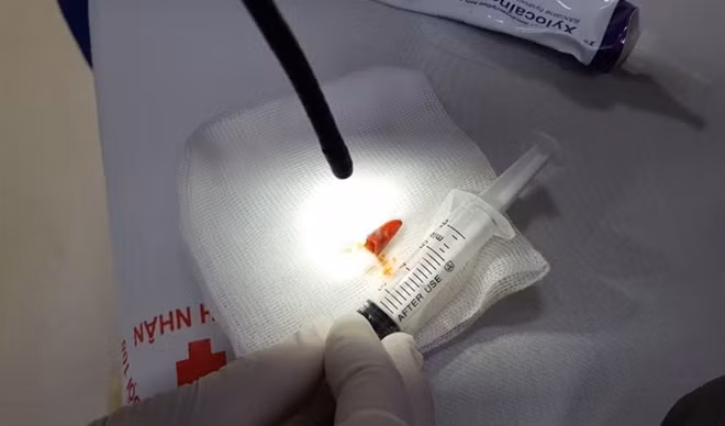 Miếng ớt được lấy ra khỏi đường thở của bệnh nhân