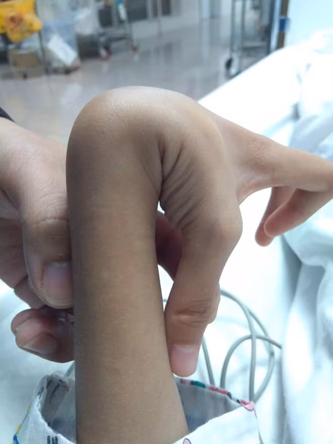 Khớp tay của bé Uyên có thể uốn được 180 độ - một biểu hiện của Hội chứng Ehlers - Danlos