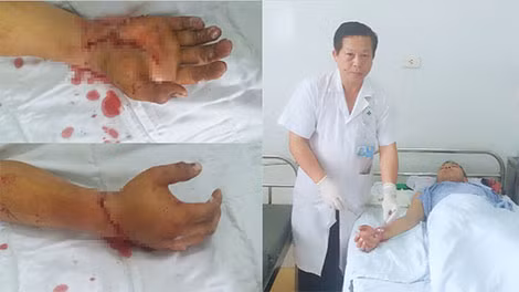 Bàn tay của bệnh nhân sau khi được nối thành công. Hậu phẫu tại buồng bệnh khoa CTCH thăm khám sau 1 ngày bàn tay vẫn hồng ấm. Bàn tay của bệnh nhân sau khi được nối thành công. Hậu phẫu tại buồng bệnh khoa CTCH thăm khám sau 1 ngày bàn tay vẫn hồng ấm.