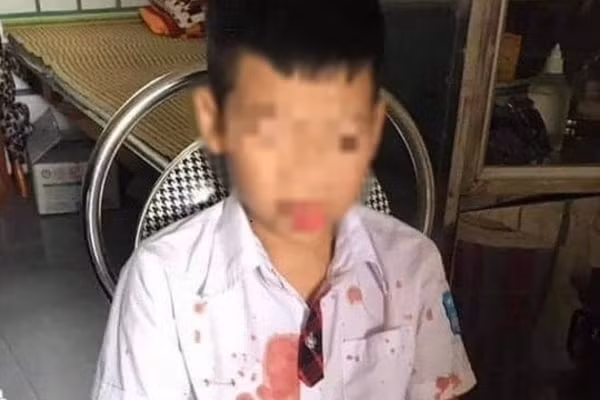 Cháu Nguyễn Gia Kh. sau khi bị hành hung.