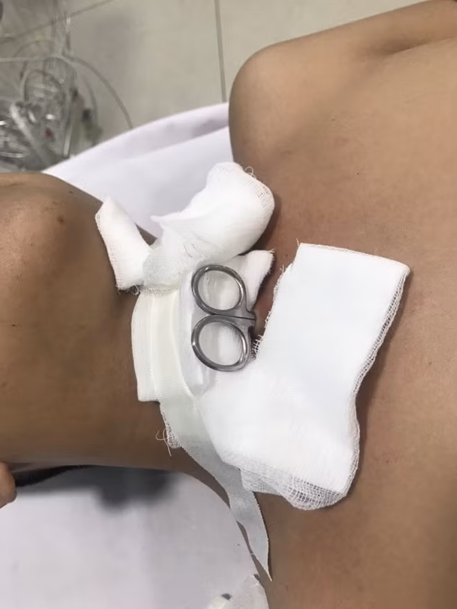 Cây kéo đâm sâu làm thủng khí quản bệnh nhân
