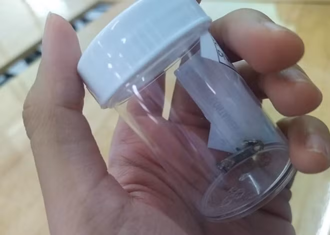 Mảnh kim loại bám chắc trong phổi bé trai suốt 2 tháng đã được lấy ra an toàn.