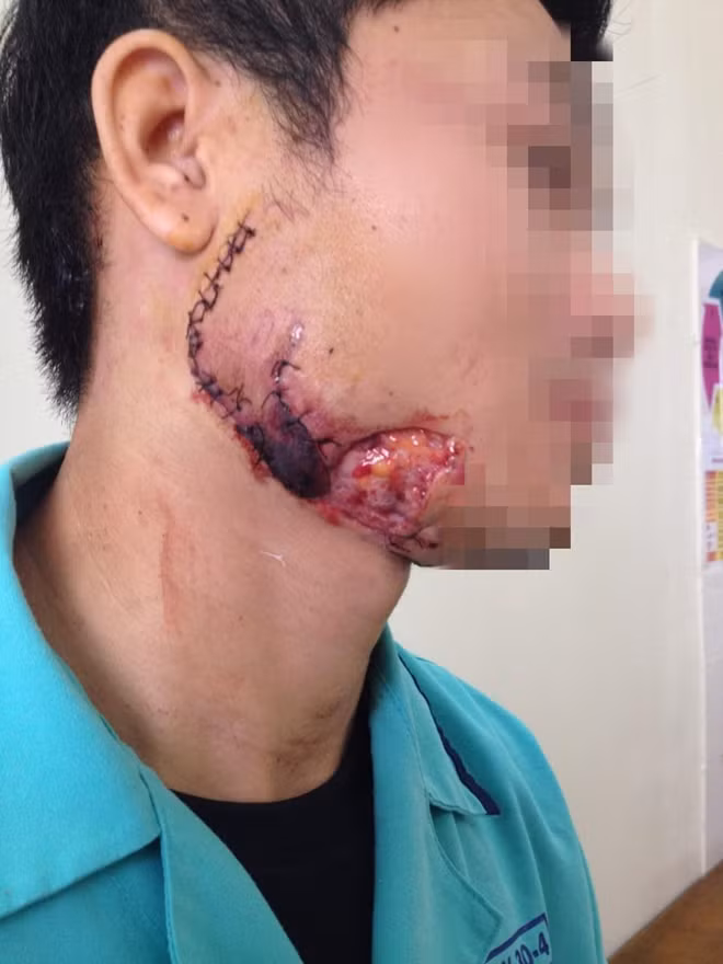 Một bệnh nhân khi tới với khoa tai mũi họng trong tình trạng bị thương khuyết hổng mảng lớn vùng cằm, mặt bên phải