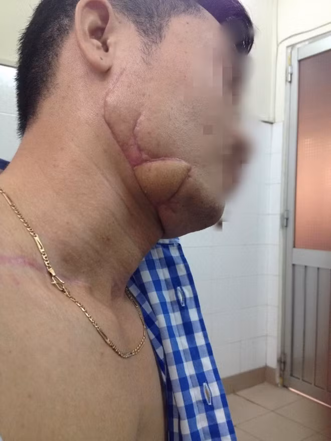 Hành trình lấy lại khuôn mặt cho bệnh nhân qua phẫu thuật tạo hình thẩm mỹ thành công tại BV 30/4