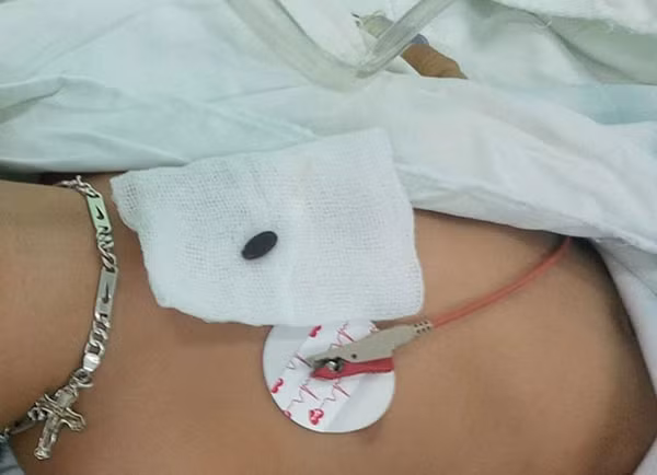 Hạt dưa được các bác sĩ bệnh viện TW Huế lấy ra từ phế quản cháu bé.