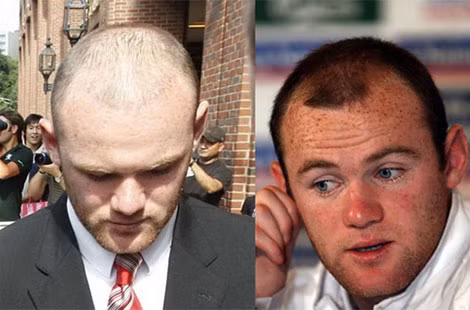 Rooney tốn tiền cấy tóc nhưng “hói vẫn hoàn hói”.