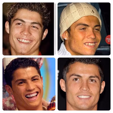 Khuôn mặt của Cristiano ronaldo đã thay đổi rất nhiều nhờ dao kéo.