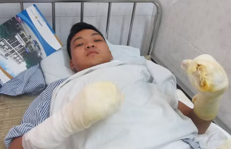 Chiến sĩ Nguyễn Văn Quang nằm điều trị tại Viện bỏng Quốc gia.