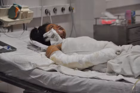 Bé Linh đang có nguy cơ cao sốc nhiễm trùng vì tổn thương bỏng quá nặng.