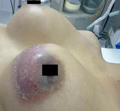 Một ca biến chứng khi đi nâng ngực. Ảnh có tính minh họa
