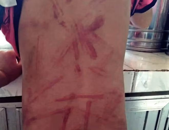 Vết bầm tím trên lưng của cháu A. do bà E. đánh (Ảnh: M.X.H).