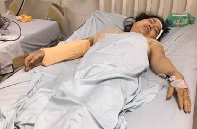 Bà Q đang điều trị thương tích tại Bệnh viện Đa khoa tỉnh Phú Yên. Ảnh: M.N