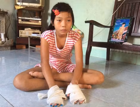 Mỗi ngày anh Lâm bó tay cho con ba lần.