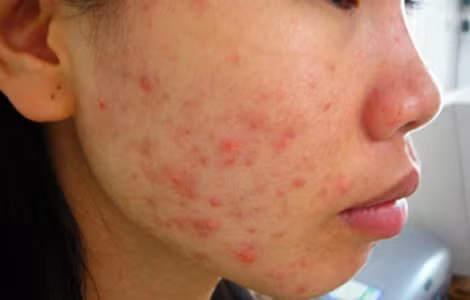 Trắng da đâu chưa thấy, chỉ thấy sần sùi.