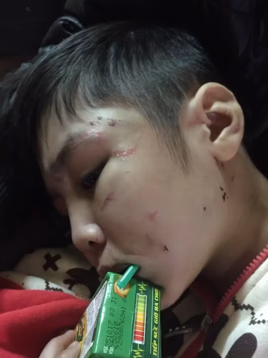 Cháu K. vẫn chưa hết hoảng loạn vì bị bố đẻ và dì ghẻ giam cầm trong nhà trọ, ko cho đi học, và bị bạo hành trong thời gian dài