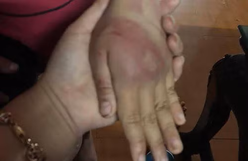 Tay cháu N bị thâm tím do bị bố đánh