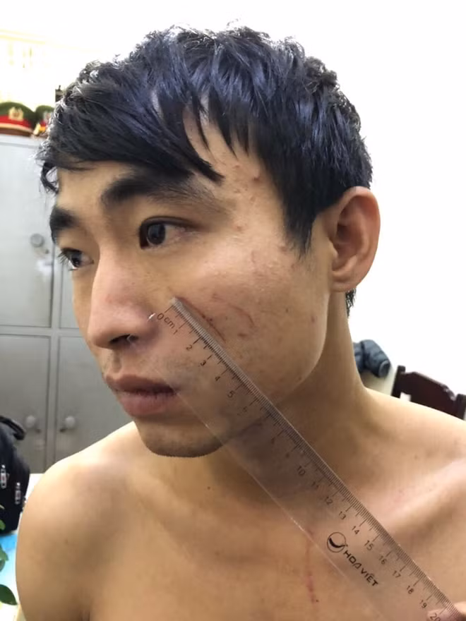 Đối tượng Đỗ Huy Tùng với những vết xước trên mặt do bị nạn nhân cào trong lúc vật lộn