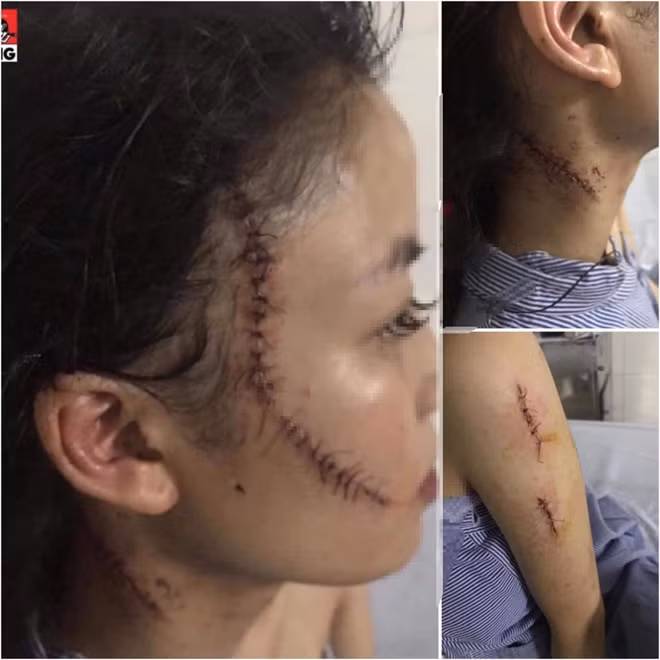 Nạn nhân với nhiều vết thương khắp người