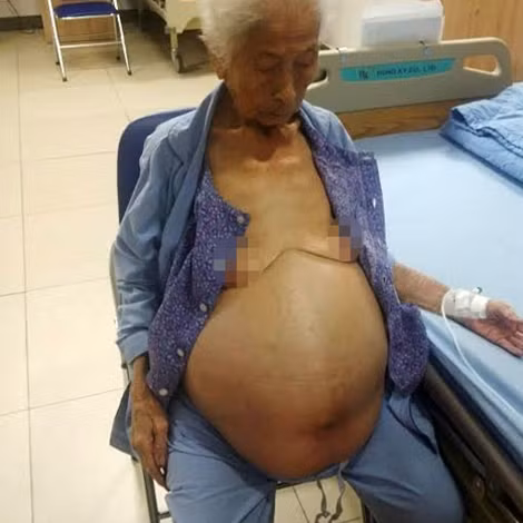 Cụ Chiên với khối u trong ổ bụng trước khi mổ.